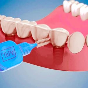 Cómo limpiar prótesis dentales